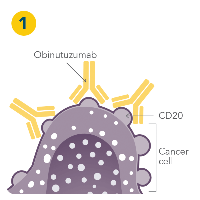 Diagram showing obinutuzumab attaching to the CD20 protein on the surface of a cancer cell and stopping its growth - Step 1